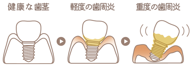 歯周病の進行