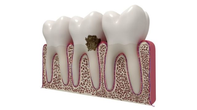 虫歯の説明用模型