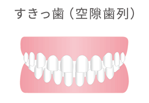 すきっ歯（空隙歯列）