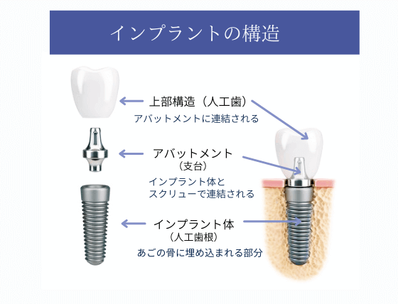 インプラントの構造