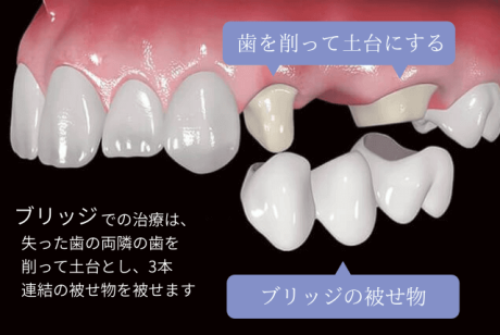 ブリッジについて