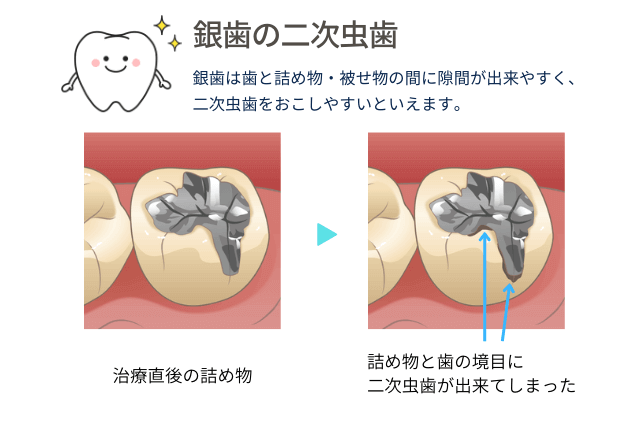 銀歯の二次虫歯