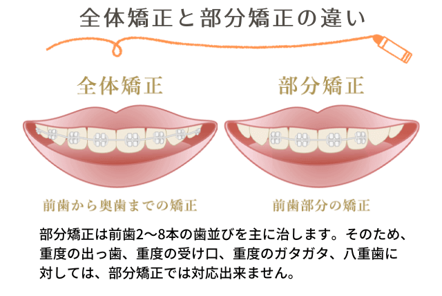 全体矯正と部分矯正の違い