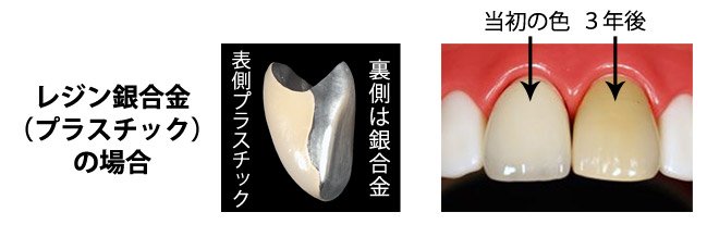 進行 を 止める 虫歯 の