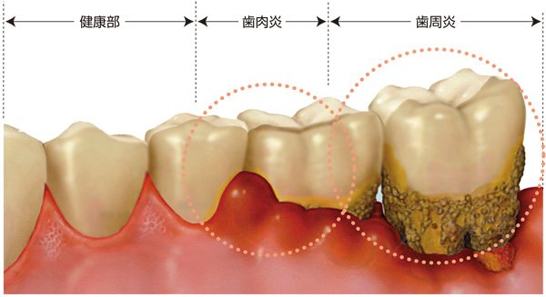 歯周病と歯肉炎